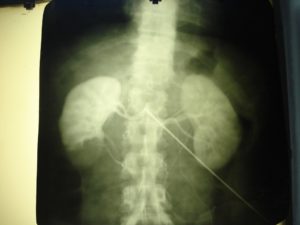 Рентген почки с йодом