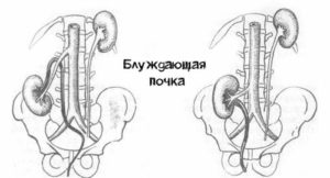 Опущение почки у женщин симптомы и лечение