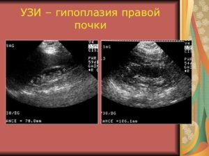 Диета при гипоплазии почки