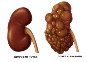 Киста почки может ли болеть