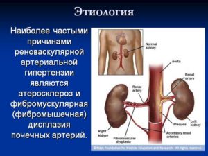 Стеноз почечных артерий и артериальная гипертония