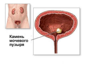 Камни в мочевом пузыре симптомы у мужчин