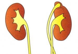 Как лечить члс обеих почек