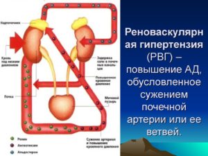 Почки и высокое нижнее давление