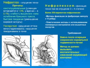 Нефроптоз 1 степени лечение