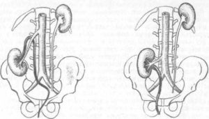 Нефроптоз справа при беременности