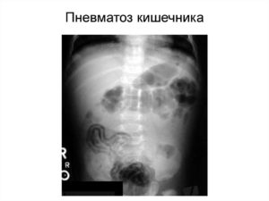 Что означает пневматоз почки