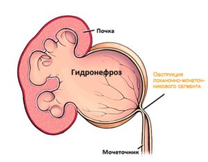 Стентирование при гидронефроз почек у детей