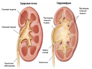 Каликопиелоэктазия почек у детей что это такое