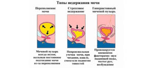 Недержание мочи при чихании у женщин как лечить