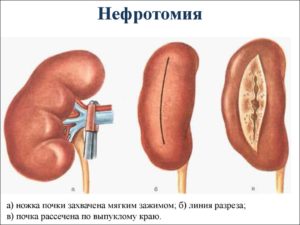 Сосудистые ножки почек