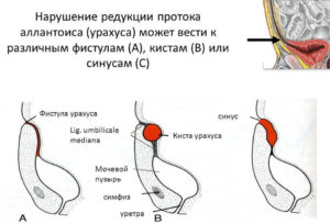 Киста урахуса операция