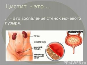 Цистит это инфекционное заболевание или нет