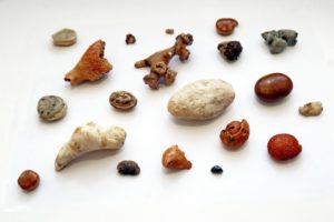 Что способствует появлению камней в почках