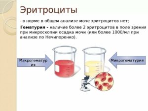 Эритроциты 13 в моче у ребенка