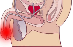 Зуд в уретре у мужчин