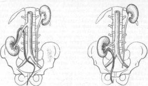 Двусторонний нефроптоз как лечить