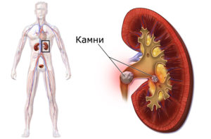 Где могут быть камни в организме человека
