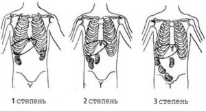 Опущение почки до 1 степени