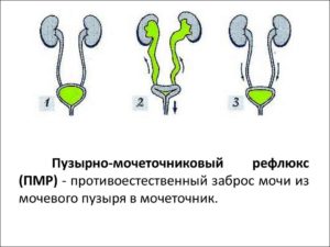 Рефлюкс мочевого пузыря у детей лечение