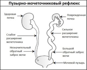 Рефлюкс мочевого пузыря у детей лечение