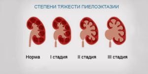 Эхопризнаки пиелоэктазии левой почки у грудного ребенка