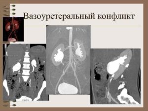 Пиеловазальный конфликт почек лечение