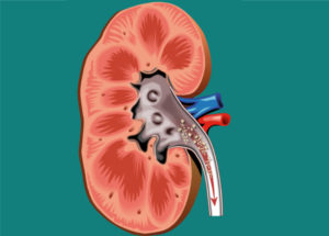 Откуда образуется песок в почках
