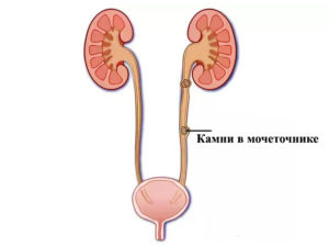 Камень в нижней трети мочеточника как вывести