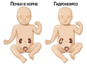 Пиелоэктазия почки слева у новорожденного