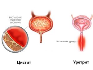 Как отличить уретрит или цистит у женщин