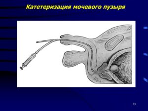 Катетеризация мочевого пузыря манипуляция