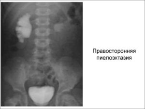 Нефроптоз и пиелоэктазия почки