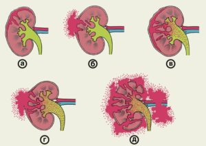 Что делать если пробили почку