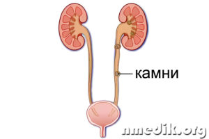 Камни в почках и мочеточниках лечение