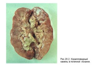 Признаки конкрементов почек что это такое