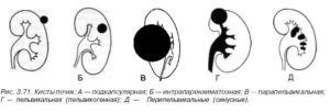 Киста в лоханке почки чем лечить