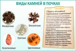 Какую минеральную воду можно пить при камнях в почках