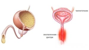 Цистоуретрит у женщин