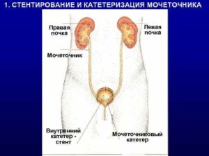 Кровь в моче после стентирования мочеточника