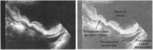 Утолщение задней стенки мочевого пузыря у женщин