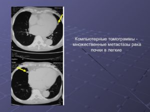 Метастазы почек рак