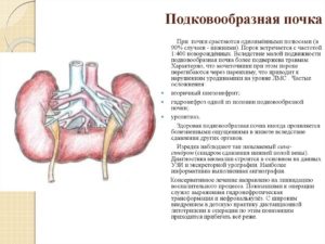 Инвалидность подковообразная почка