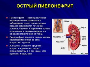 Острый пиелонефрит слева