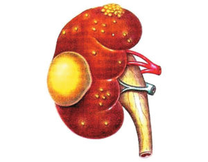 Гнойный пиелонефрит что это такое