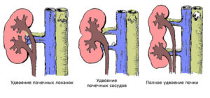 Расщепление синусов почек