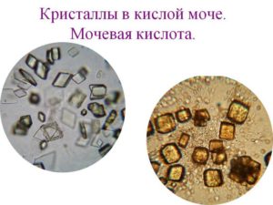 Кристаллы в моче при беременности