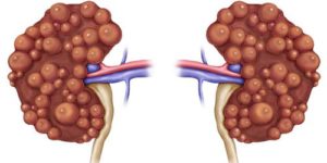 Киста на почке симптомы и лечение народными средствами