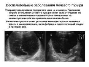 Узи при цистите и уретрите у женщин