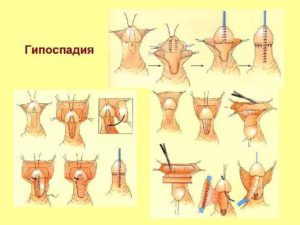 Стволовая гипоспадия у мальчиков